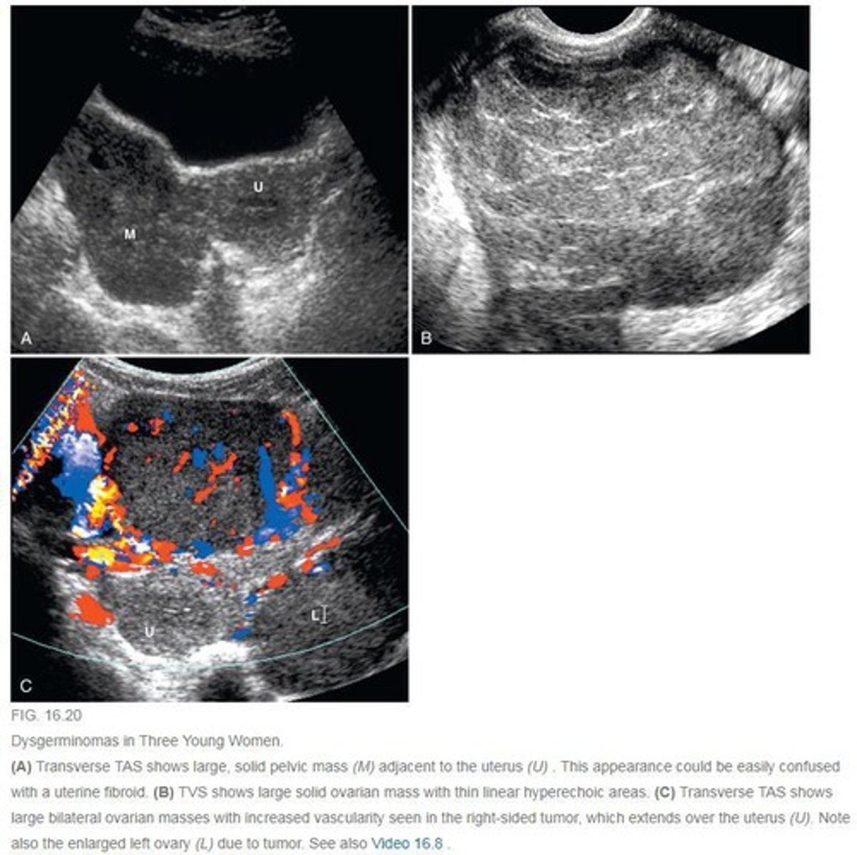 <p>- Mature cystic teratoma (benign)</p><p>- Dysgerminomas (malignant)</p><p>- Serous cystadenoma</p>