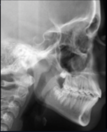 <p>what class of occlusion is shown in this x-ray? </p>