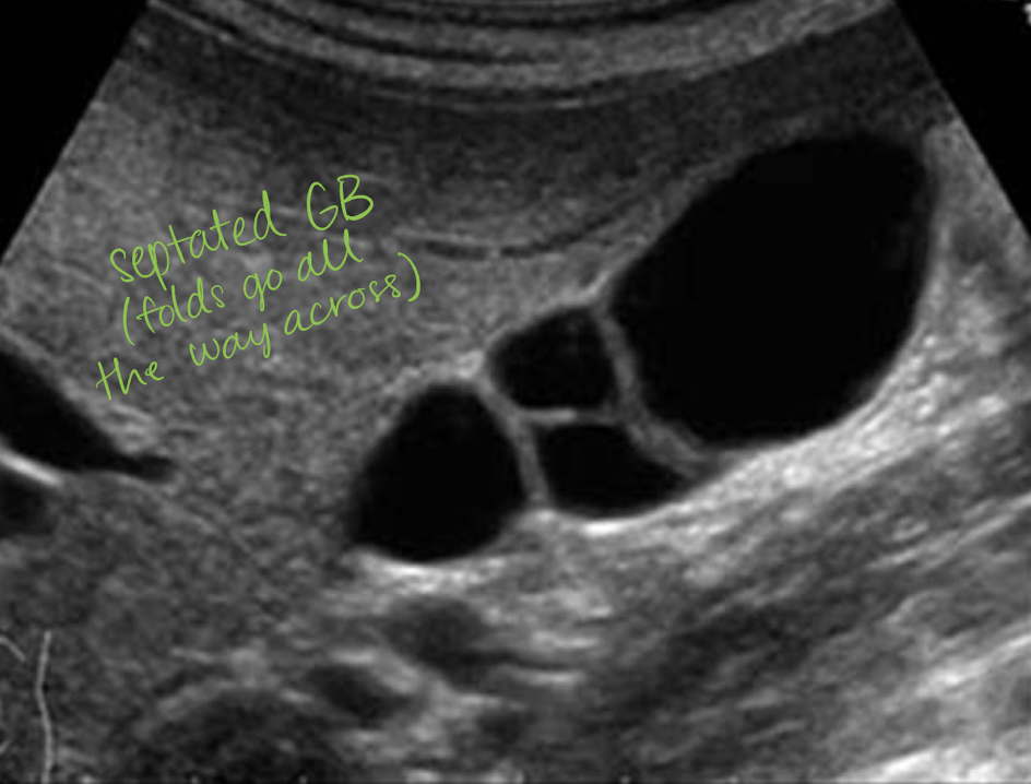 <ul><li><p><mark data-color="yellow" style="background-color: yellow; color: inherit;">internal division(s) of GB</mark>—hyperechoic line</p></li></ul><ul><li><p>goes <u>all the way across</u></p><ul><li><p>if not then it is likely a fold</p></li></ul></li><li><p>associated with cholelithiasis </p></li></ul><p></p>