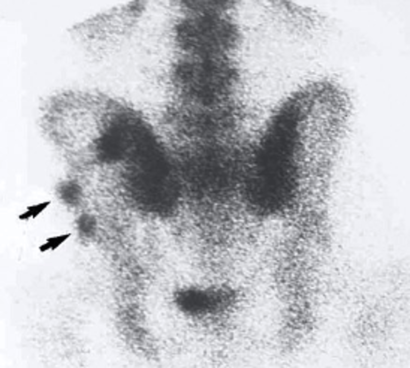 <p>what type of imaging study is this?</p><p>a. Radionuclide bone scan</p><p>b. ultrasound</p><p>c. PET scan</p><p>d. mammogram</p>