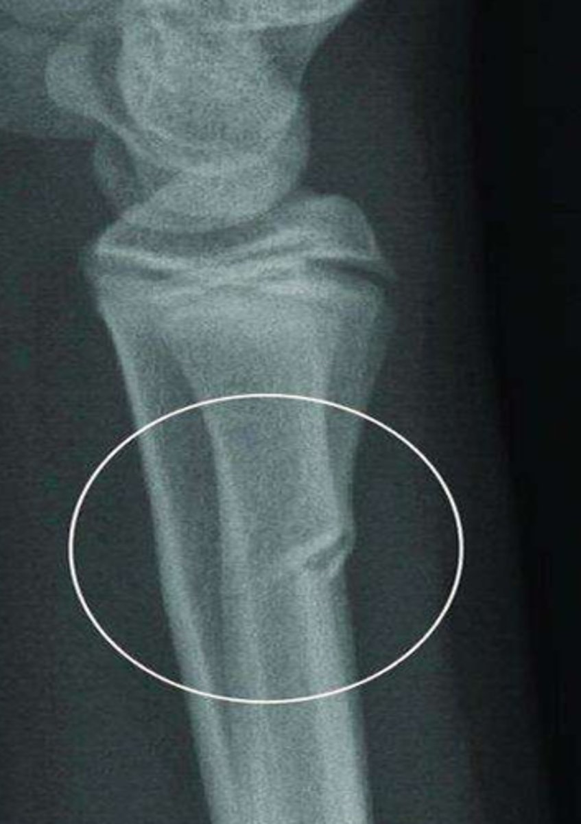 <p>What type of fracture is this?</p>