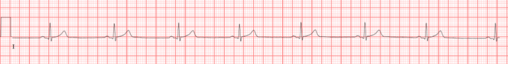 <p>a type of arrhythmia characterized by a heart rate of less than 60 beats per minute, with a regular rhythm and normal P waves</p>