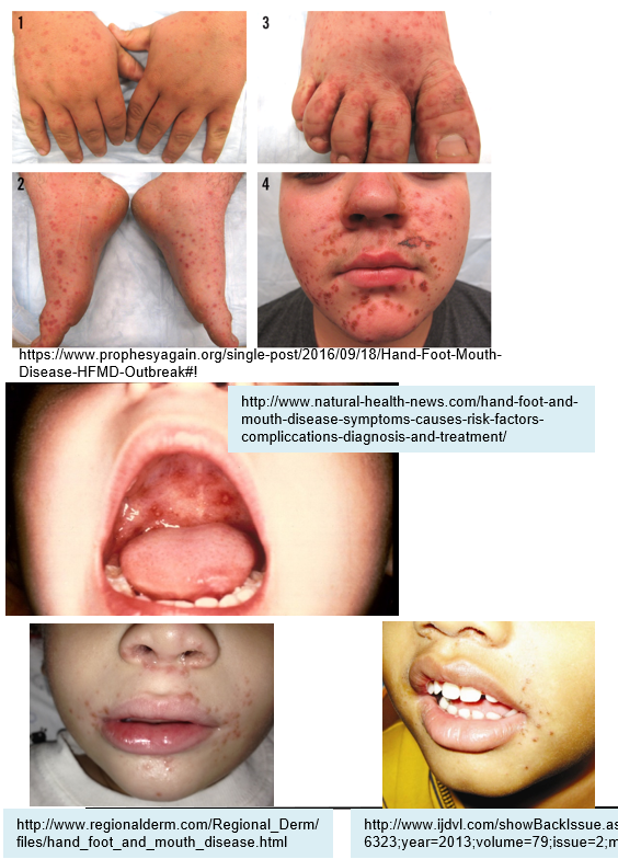 <p>It causes <strong>vesicular lesions</strong> on the <strong>hands</strong>, <strong>soles of feet</strong>, <strong>mouth</strong>, and <strong>tongue</strong>. It is usually <strong>self-limiting</strong>.</p>