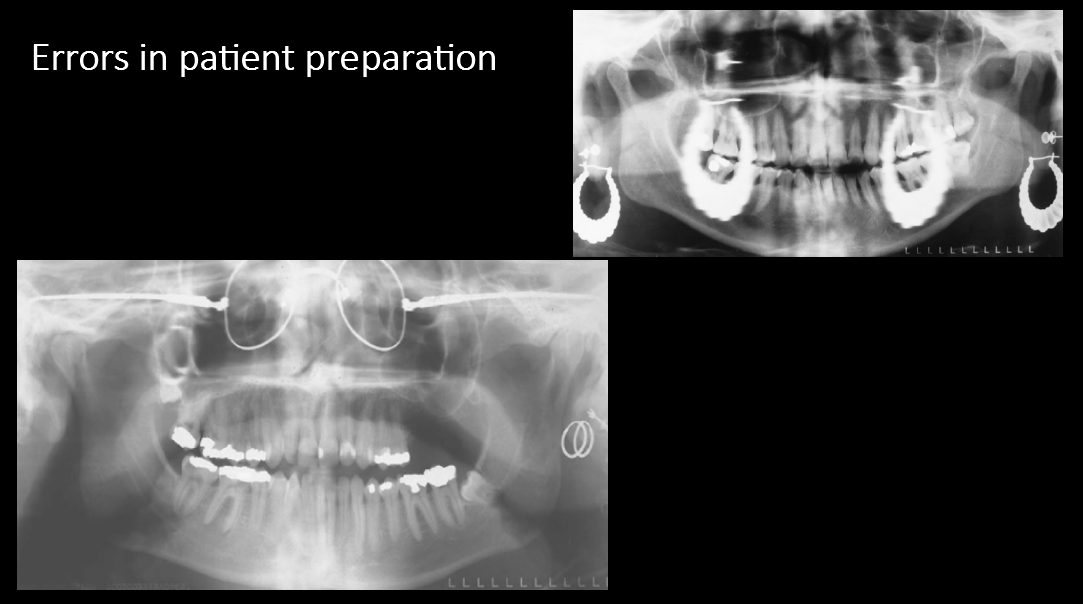 <p>Errors in patient preparation</p>