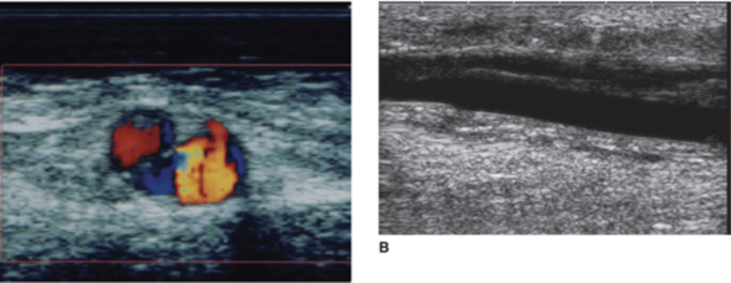 <p>Intimal flap parallel to vessel walls</p><p>Turbulent color in either lumen</p><p>Bidirectional spectral</p><p>Increased resistance</p>