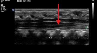 <p>The central echogenic complex in the spinal cord represents what?</p>