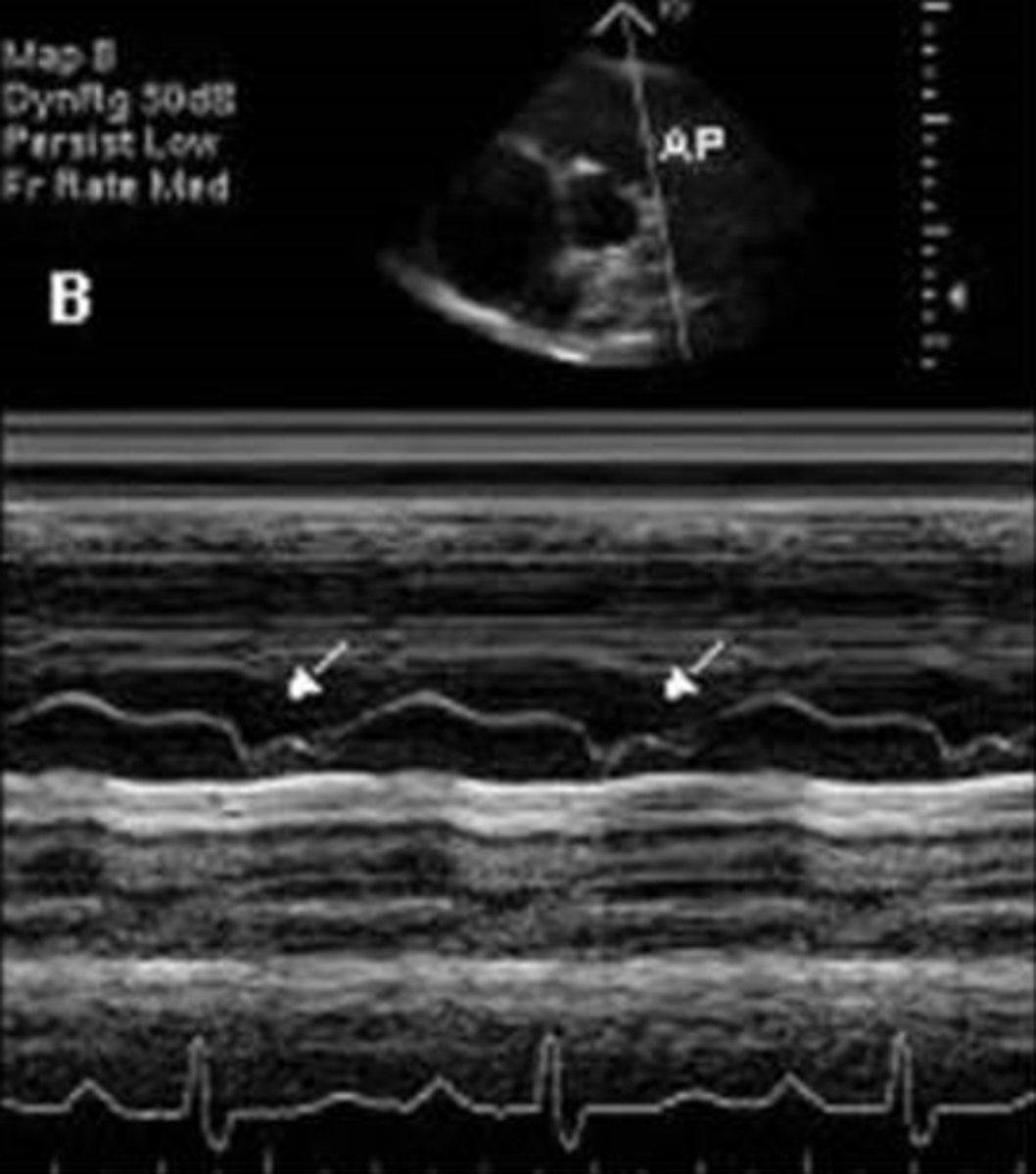 <p>for PV, have the DEFAC as mitral and in case of PHTN, you will see what is known as "___________"</p>