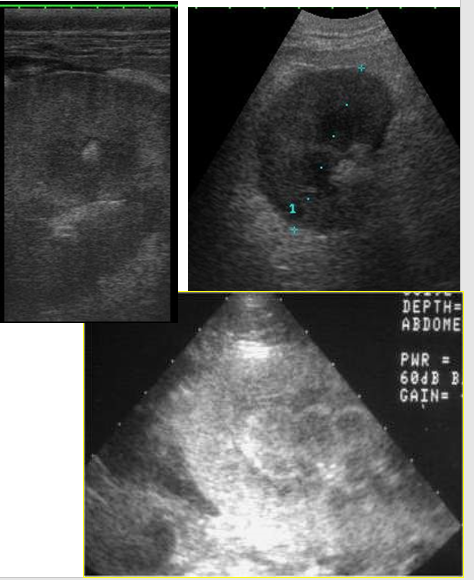 <p>Rounded, hazy kidney</p><p>Reduced corticomedullary definition</p><ul><li><p>Nephritis</p></li><li><p>Tubular necrosis</p></li><li><p>Acute renal failure</p></li></ul><p>Appearance could be normal in acute disease</p>