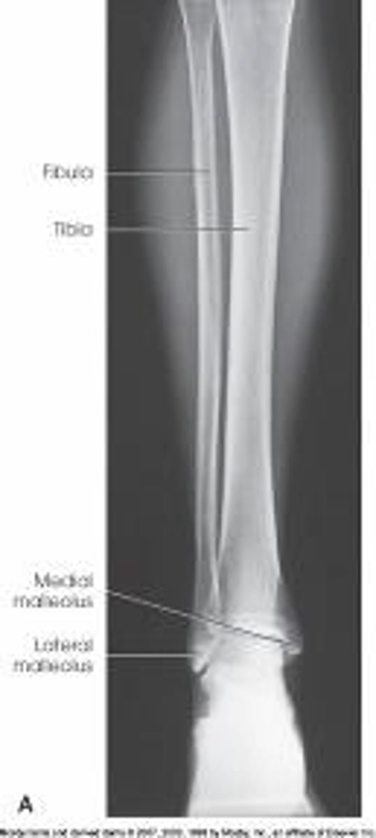 <p>What is needed to complete the projection of the lower leg in the image below?</p><p>Nothing. This is a complete projection.</p><p>An AP of the knee and proximal leg</p><p>An AP of the ankle and distal leg</p><p>A lateral projection of the knee</p>