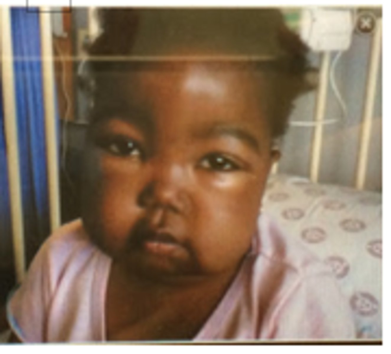 <p>associated with diseases such as renal failure</p>