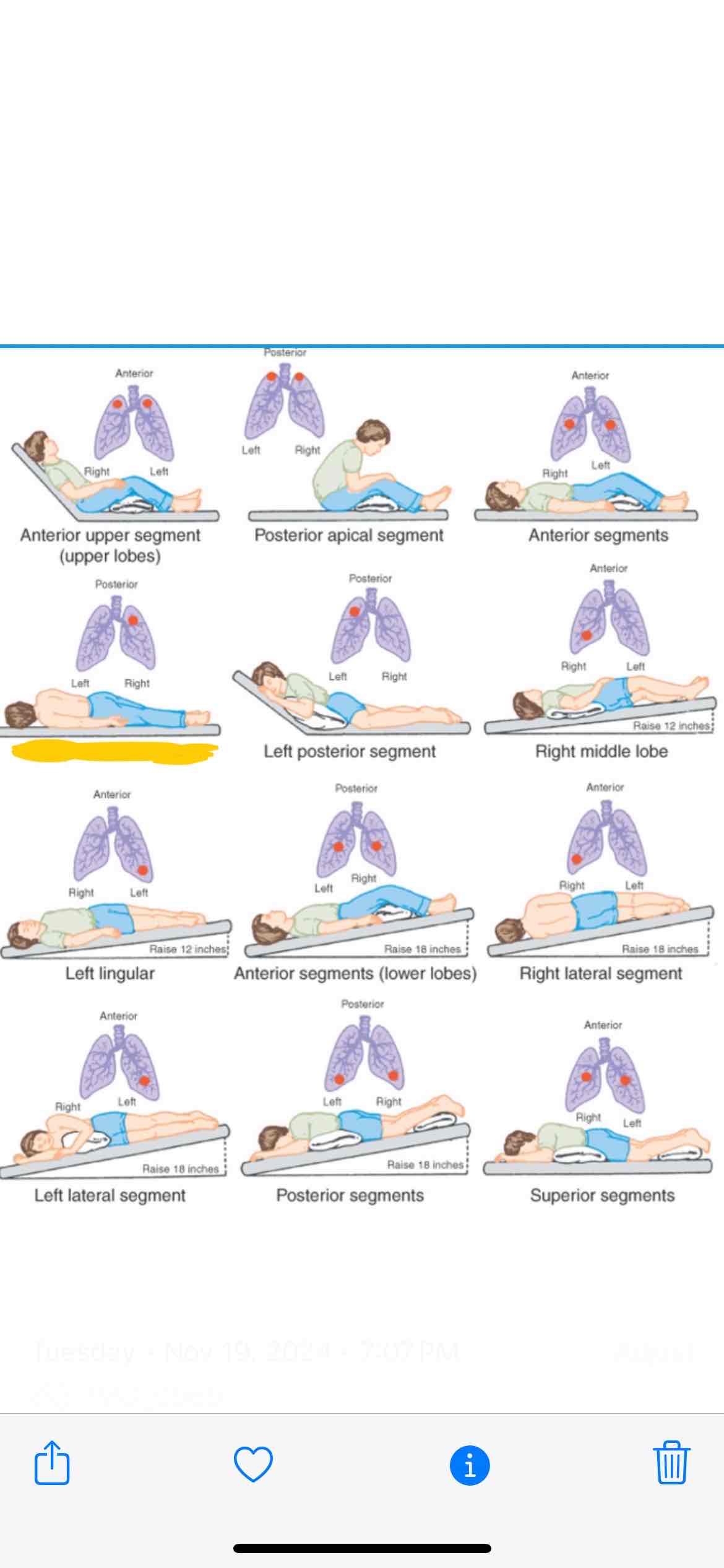 <p><span>Which lung segment does this position effect</span></p>