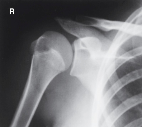 <p>evaluation criteria for AP posterior oblique shoulder (grashley method)</p>