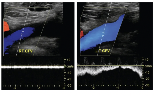 <p>Why do we compare phasicity of venous waveforms side to side</p>