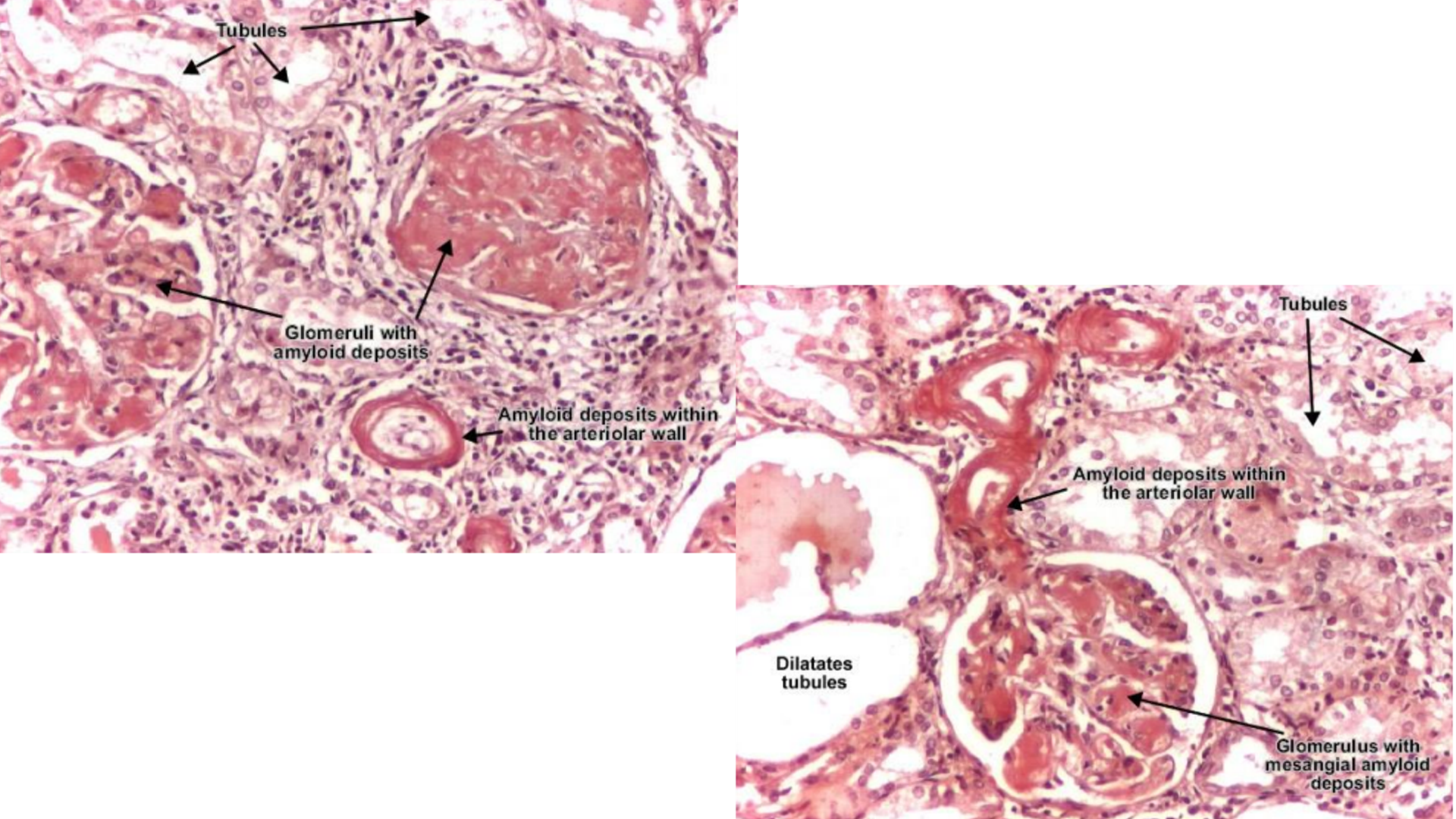 <p><span>Renal Amyloidosis</span></p>