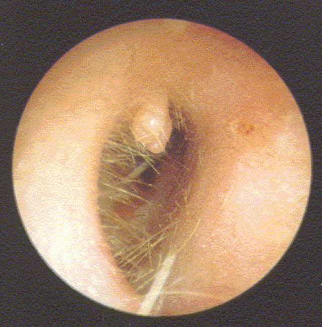 <p><u>disordered otoscopy: canal</u></p><p>papilloma</p>