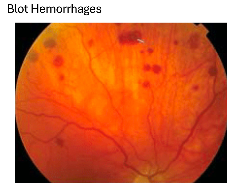 <p>blot hemorrhages</p>