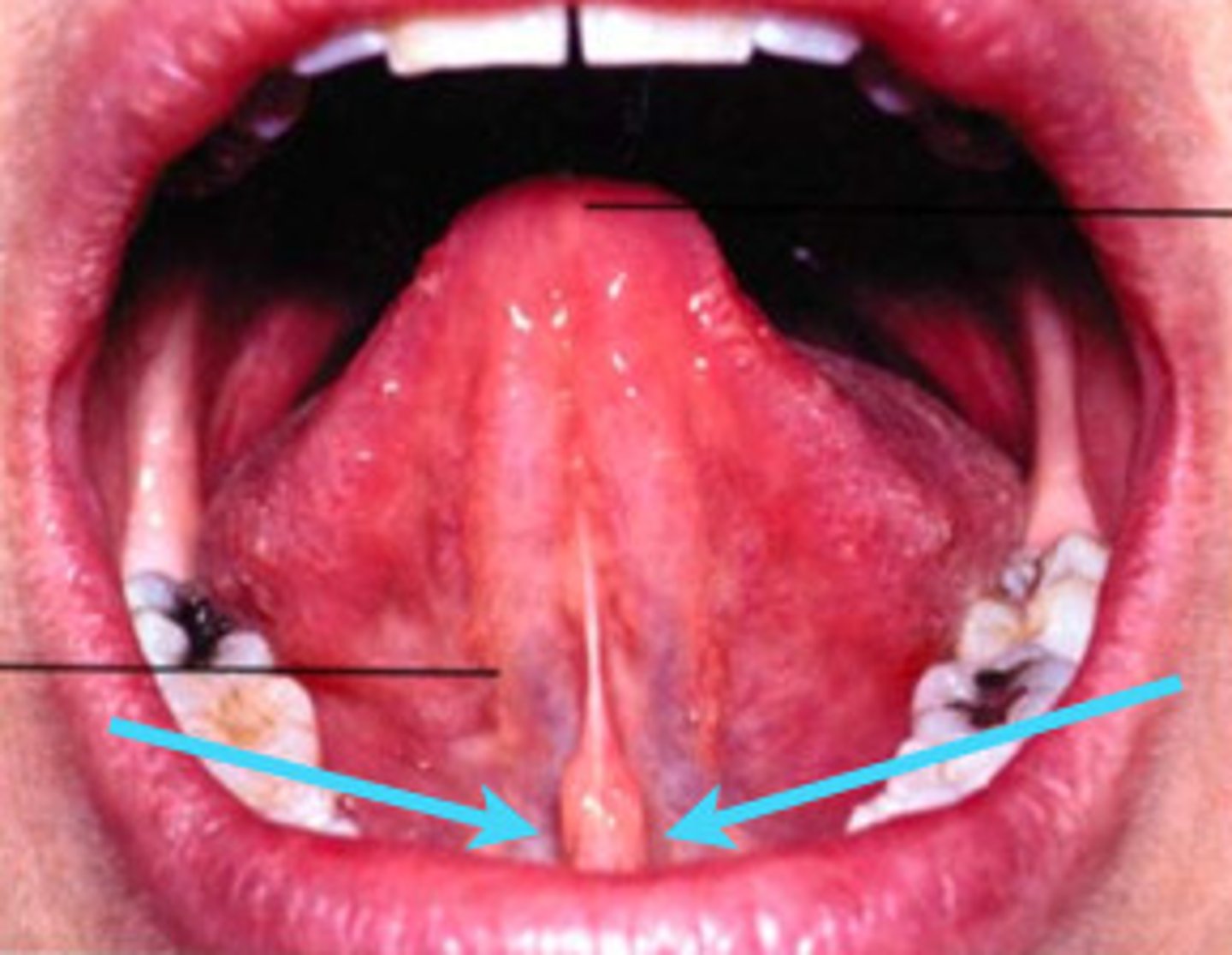 <p>Small elevation on each side of the base of the lingual frenum. It is the opening for the ducts of 2 major salivary glands, submandibular and sublingual glands.</p>