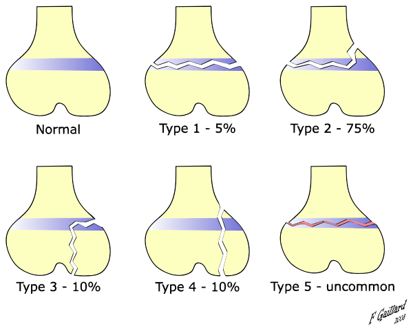 Salter-Harris Fractures Classification