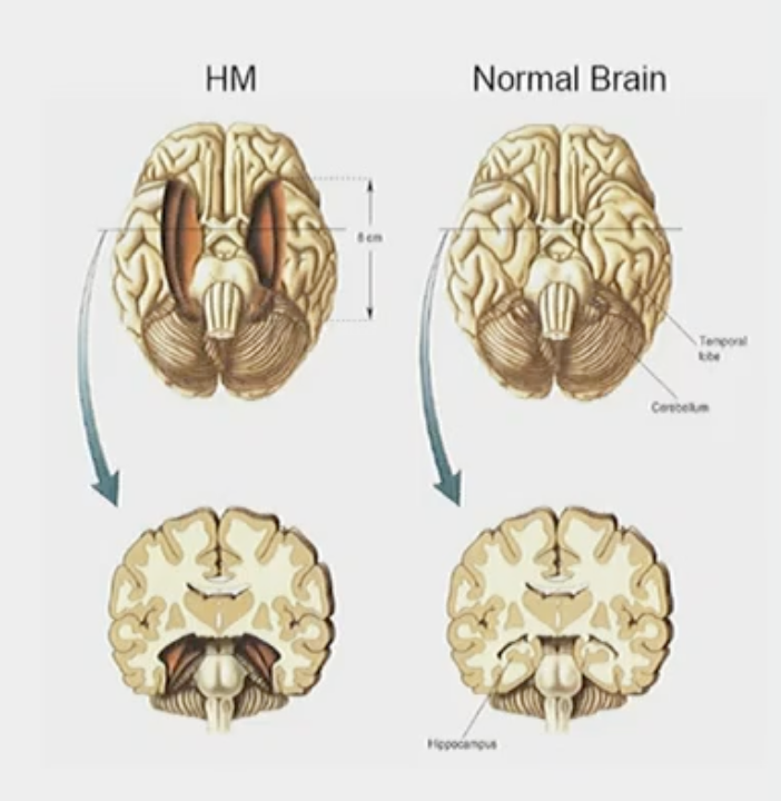 <p><strong>Patient H.M </strong></p><p></p><p>His seizures started at 10 years old and they kept getting more severe to the point where, at 27, he couldn’t work since they were becoming intractable. </p><p></p><p>Hence, his doctors decided that since the seizures were starting from the Medial Temporal Lobe, they should remove it completely and that should stop his seizures. </p><p></p><p>His seizures stopped but he lost his ability to consolidate memories—he got anterograde amnesia from it. </p>