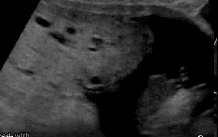 <p>a pregnant pt w/<strong>recent acute </strong>onset of <strong>hypertension</strong>, nausea, vomit. she has <strong>no pain, cramping</strong>, or vaginal <strong>bleeding</strong>.</p><p>.</p><p>a prior US exam at 6w shows the pregnancy should now be 17w6d GA.</p><p>.</p><p>what maternal serum level is <strong>abn elevated</strong></p><p>.</p><p>a) acetylcholinesterase</p><p>b) bHCG</p><p>c) AFP</p><p>d) inhibin A</p>