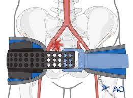 <ul><li><p>used to splint the bony pelvis to reduce hemorrhage </p></li></ul><p></p>