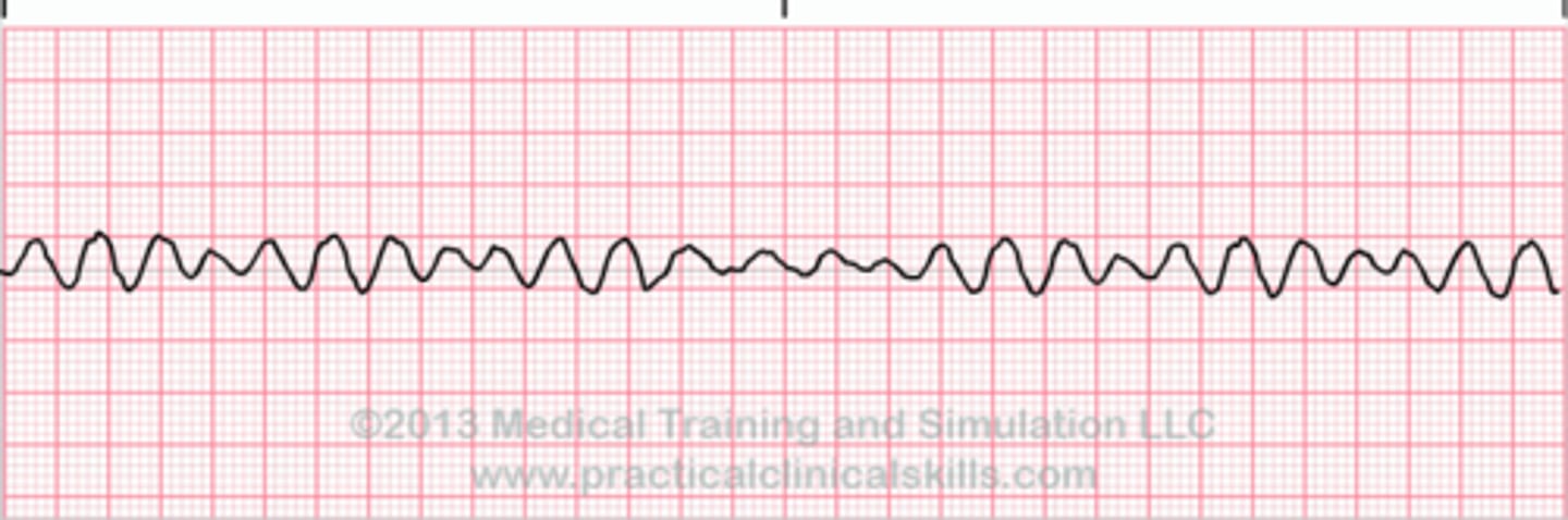 <p>you are dead, ventricles are quivering, clients have no pulse/BP/RR. fatal if not terminated in 3-5 minutes. Want Coarse v fib rather than fine because there is more of a rhythm to shock.</p>