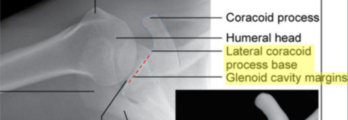 <p>Inferior border of the glenoid cavity and base of the coracoid process</p>