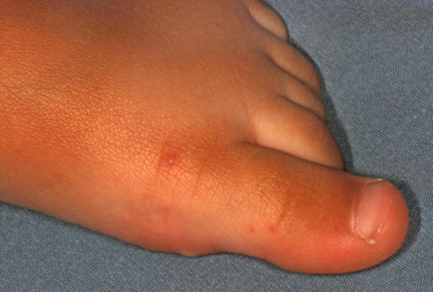 <p>hand, foot, and mouth disease (HFM); macules and vesicles on the hands and feet is what helps differentiate it from primary herpes</p>