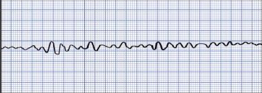 <p>What is likely responsible for the ECG tracing above?</p><p>a. dislodged pacemaker lead b. myocardial infarction of the left atrium c. a fit of coughing during the ECG d. presence of an aortic aneurysm e. embolism of the left coronary artery causing 99% blockage</p>