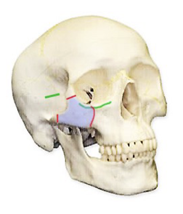 <p>What would a fracture in this area be called?</p>