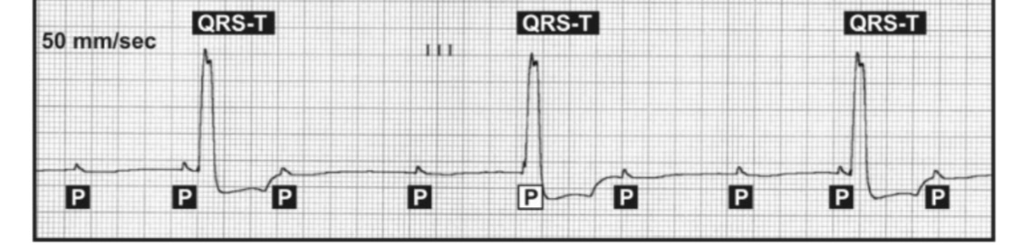 Complete heart block, causing abnormal slow HR 