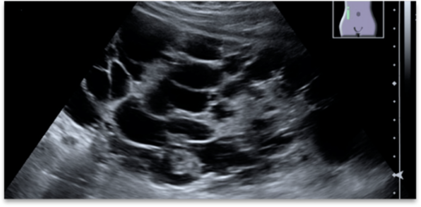 <p>-large kidneys with multiple asymmetrical cysts varying in size and location in the cortex and medulla</p><p>-sinus obliterated</p>
