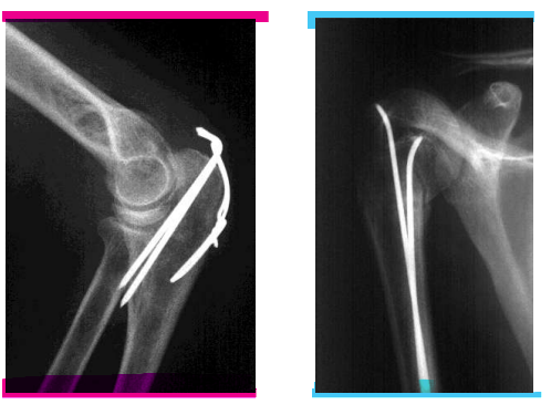 <p>Operative Frakturbehandlung</p><p><span style="color: rgb(244, 21, 21);"><strong>Zuggurtung </strong></span><strong>- </strong><span style="color: rgb(86, 25, 231);"><strong>Intramedulläre Schienung</strong></span></p><ul><li><p>Drähte wandern auch gerne mal aus</p></li><li><p>nicht so stabil</p></li></ul><p></p>