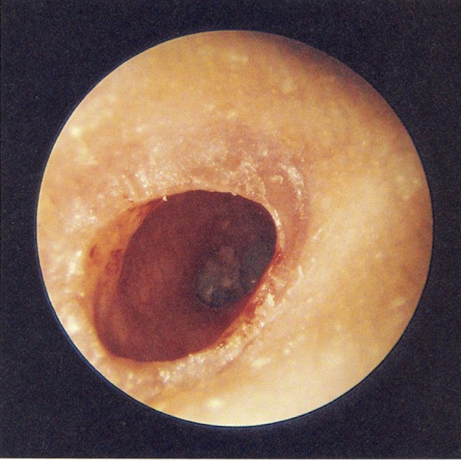 <p><u>disordered otoscopy: canal</u></p><p>stenosis of external auditory meatus</p>