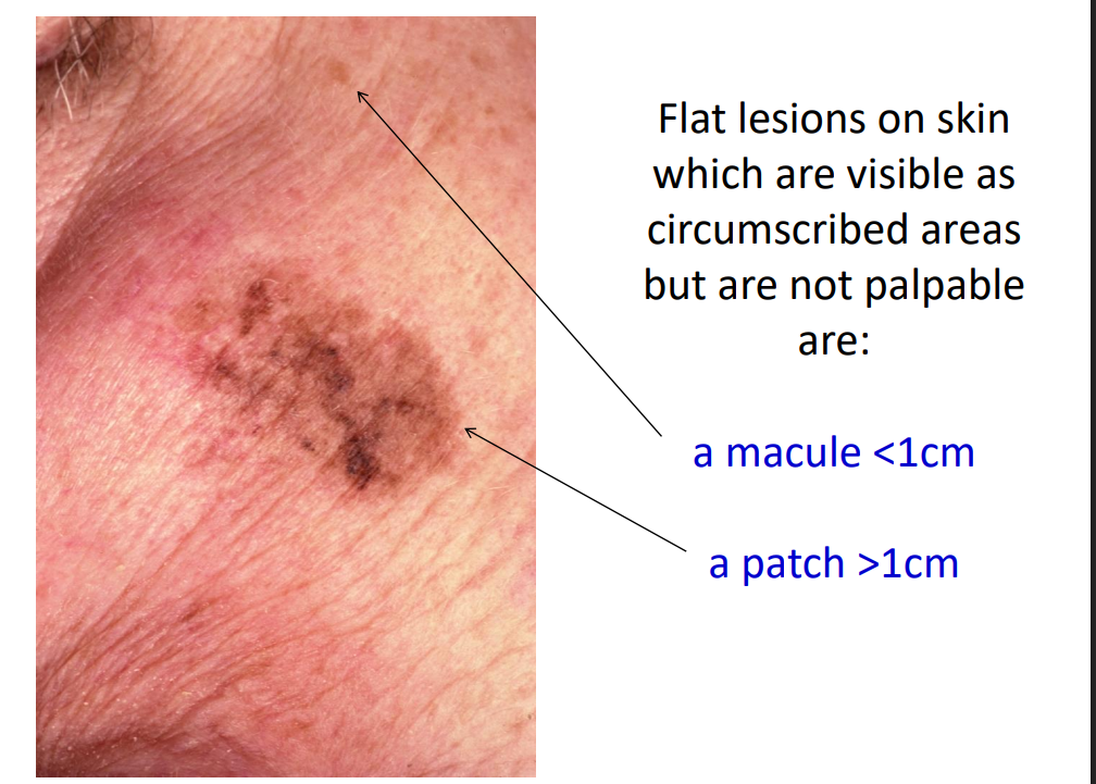 <p>a macule &lt;1cm a patch &gt;1cm</p>