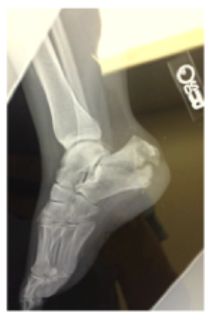 <p>Gameplan for tongue type fractures</p>