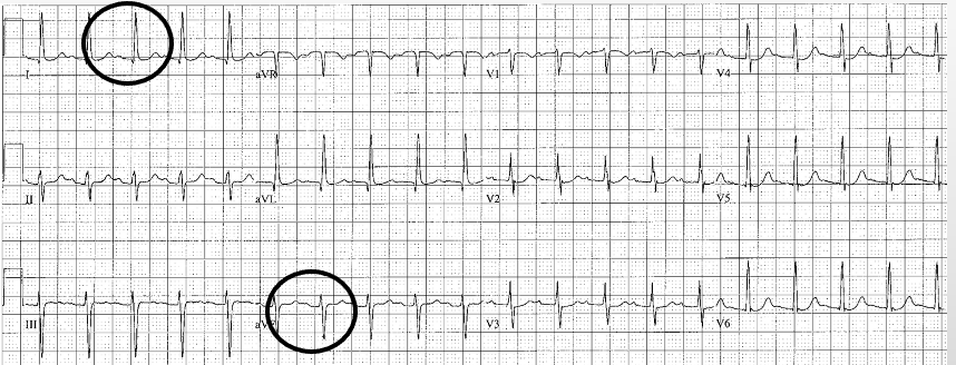 <p>Lead I is positively deflected, but aVF is negatively deflected</p>
