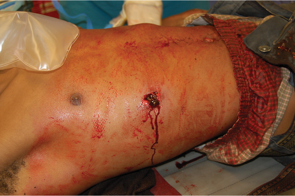 <p><span><span>Bullets travel in an unpredictable path once they are inside the patient’s body, and can therefore cause damage to multiple organs and bones.</span></span></p><img src="https://knowt-user-attachments.s3.amazonaws.com/8b2d150e-4670-4bf9-b0a4-51b6ef8cb3fb.png" data-width="75%" data-align="center" alt="knowt flashcard image"><p></p>