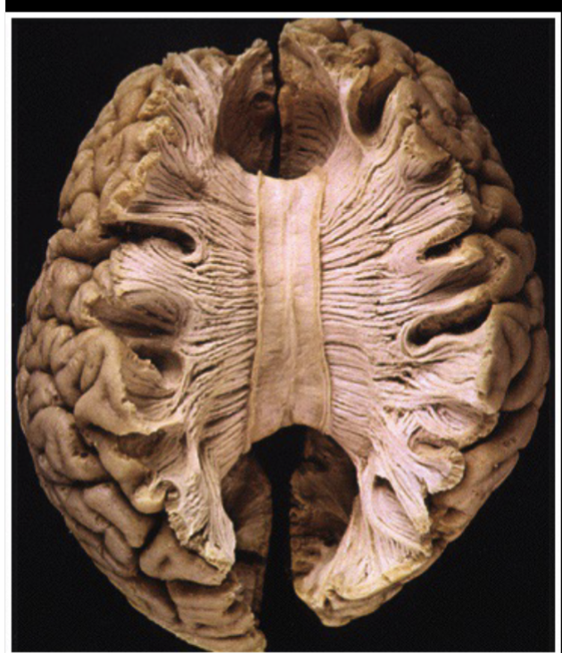 <ul><li><p>Large bundle of neural fibers (axons specifically) connecting the two brain hemispheres&nbsp;</p></li><li><p>The main pathway that links and send communication between the two hemispheres&nbsp;</p></li></ul><p></p>