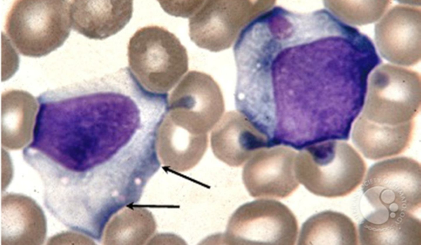 <p>-reactive lymphocytes that appear to hug RBC</p><p>-appear 1-3 weeks after onset of EBV</p>