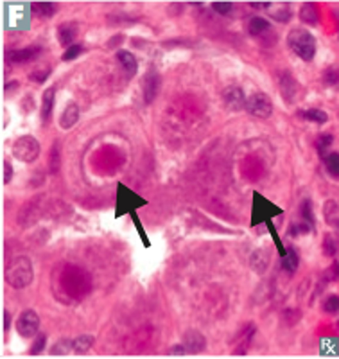 <p>compacted masses of viruses or damaged cell organelles in the nucleus and cytoplasm</p>