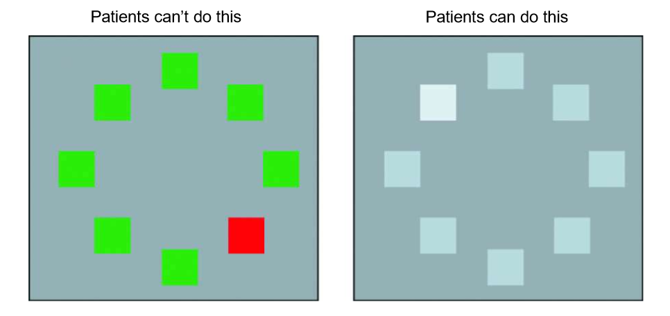 <p>= cortical colour blindness</p><ul><li><p>following a stroke / injury = patient cannot see colour at all</p></li><li><p>photoreceptors, retina, LGN, V1 = all intact</p></li><li><p>stroke affects V8 region of visual cortex</p></li></ul><p></p>