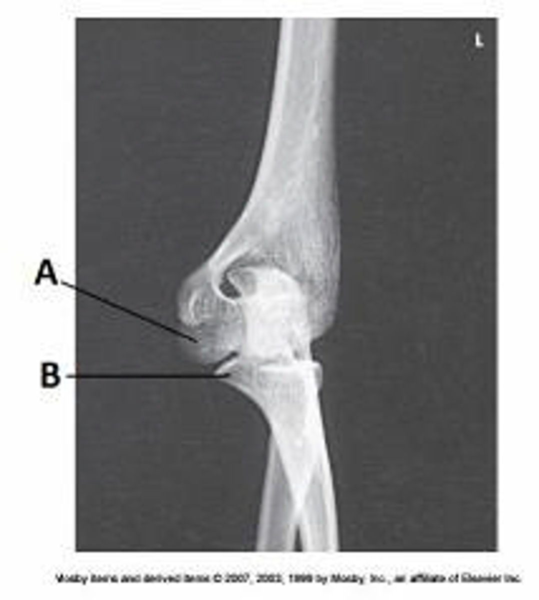 <p>What anatomy is labeled as letter B in the image below?</p><p>Capitulum</p><p>Lateral epicondyle of humerus</p><p>Trochlea</p><p>Coronoid process of ulna</p>