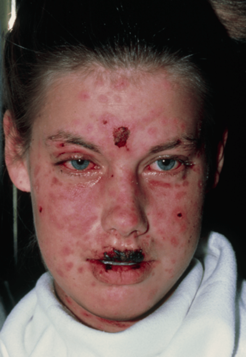 <p>-Severe cutaneous hypersensitivity reactions</p><p>-Causes: sulfa drugs, antiseizure drugs, antibiotics (most common)</p><p>-Macules and lesions rapidly spread</p><p>-Epidermal blistering, necrosis, sloughing</p><p>-Clinical syndrome</p><p>Treatment:</p><p>-TREAT AS A BURN</p><p>-Supportive care</p><p>-Cyclosporine</p><p>-Plasmapheresis</p><p>-IV immune globulin</p><p>-Corticosteroid therapy</p><p>-Tumor necrosis factor alpha inhibitors</p><p>Mortality rate:</p><p>-7.5% in children</p><p>-20-25% in adults</p><p>-Lower with early treatment</p>