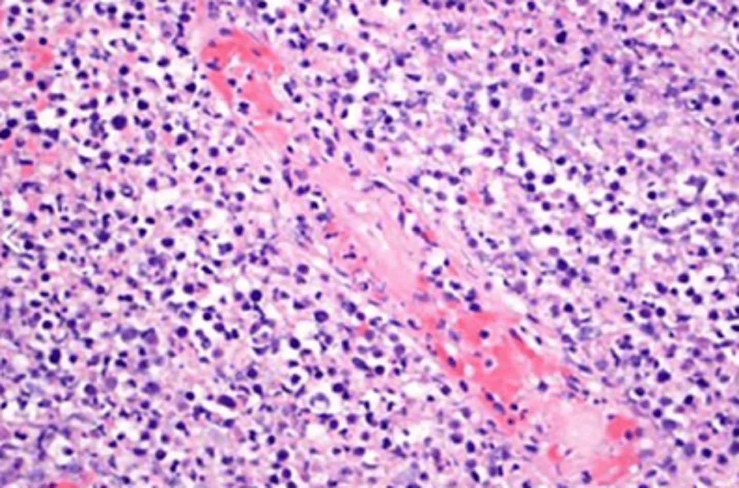 <p>A striking feature is the angiocentric distribution of the tumor cells, which surround and invade small vessels, leading to destruction of vessel walls, thrombosis and extensive ischemic necrosis.</p>