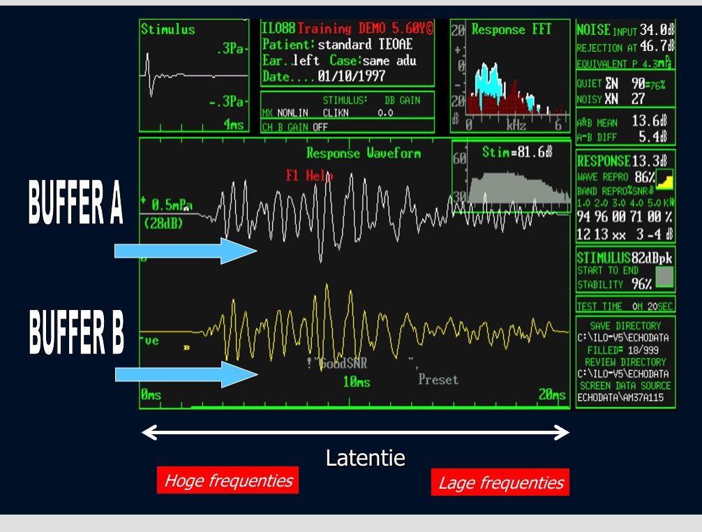 <p>hoe oscillogram interpreteren → golven die het eerst arriveren = hoge frequenties (want basaal) derna lage frequenties (liggen apicaal) = tot 20ms</p><p>latentietijd = tijd vooraleer de respons gemeten wordt</p><table style="min-width: 50px"><colgroup><col style="min-width: 25px"><col style="min-width: 25px"></colgroup><tbody><tr><td colspan="1" rowspan="1"><p><strong>Buffer A</strong></p></td><td colspan="1" rowspan="1"><p>Gemiddelde van alle even-numbered clicks (bv. 1, 3, 5...)</p></td></tr><tr><td colspan="1" rowspan="1"><p><strong>Buffer B</strong></p></td><td colspan="1" rowspan="1"><p>Gemiddelde van alle oneven-numbered clicks (bv. 2, 4, 6...)</p></td></tr></tbody></table><figure data-type="blockquoteFigure"><div><blockquote><p class="">Door deze aparte opsplitsing kan het systeem later vergelijken hoe sterk de signalen op elkaar lijken → en dus hoe betrouwbaar het resultaat is.</p></blockquote><figcaption></figcaption></div></figure><p></p>