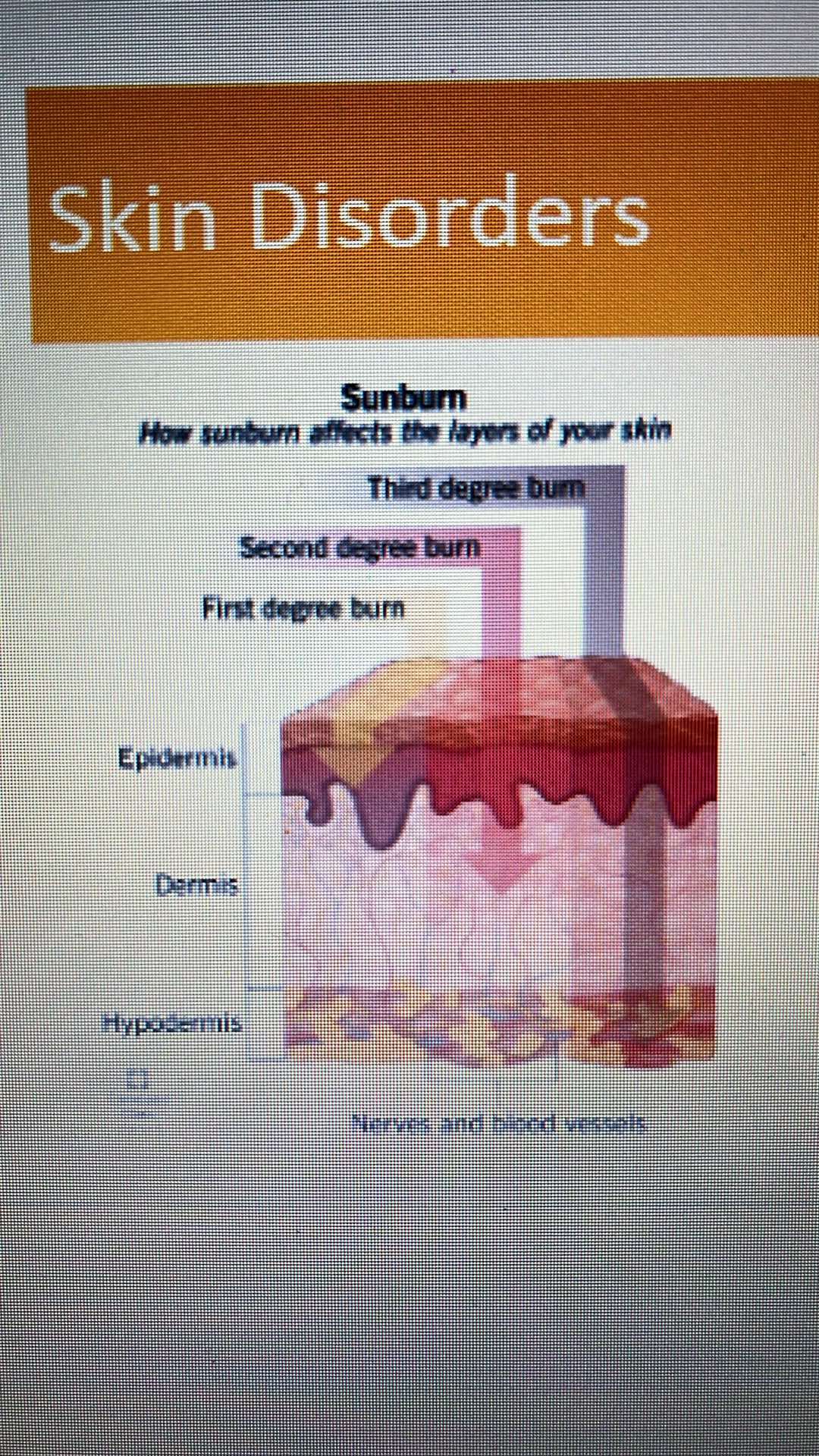 <p>1st degree burn - epidermis, dermis, hypodermis</p><p>2nd degree burn - nerves and blood vessels</p><p>3rd degree burn - including fats</p>