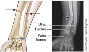 <p>A partial fracture in which one side of the bone is broken and the other side bends, similar to the way a green twig breaks on one side while the other side stays whole, but bends; occurs only in children, whose bones are not fully ossified and contain more organic material than inorganic material.</p>