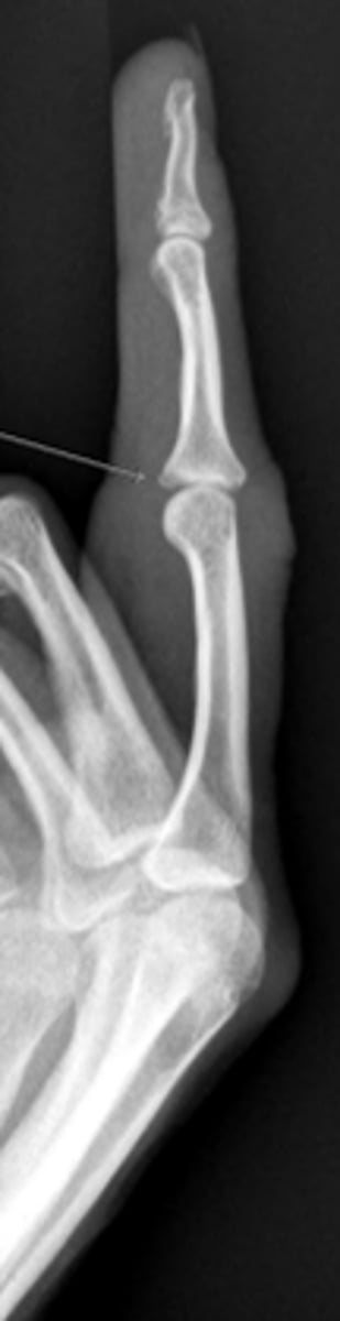 <p>PIP of the third finger, swollen</p>