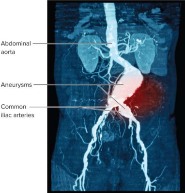 <p>Aneurysm</p>